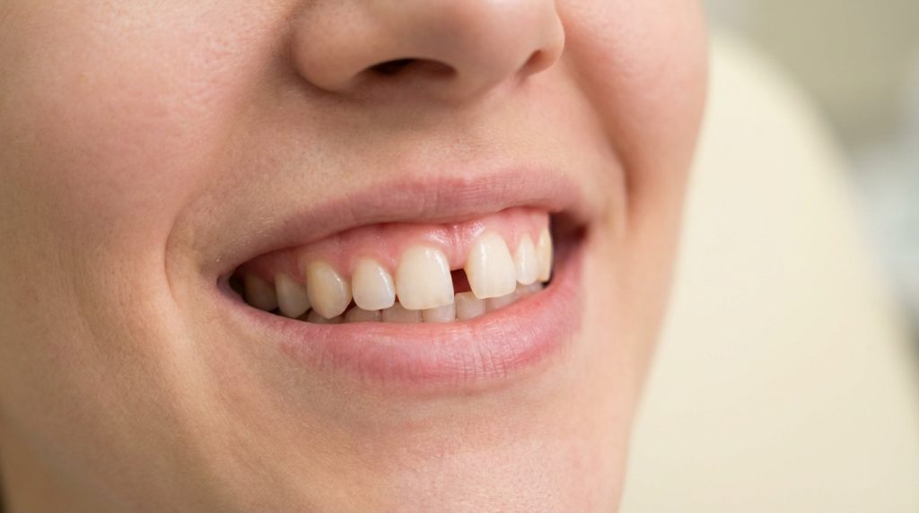 Diastema diş arası boşluk yakın çekim