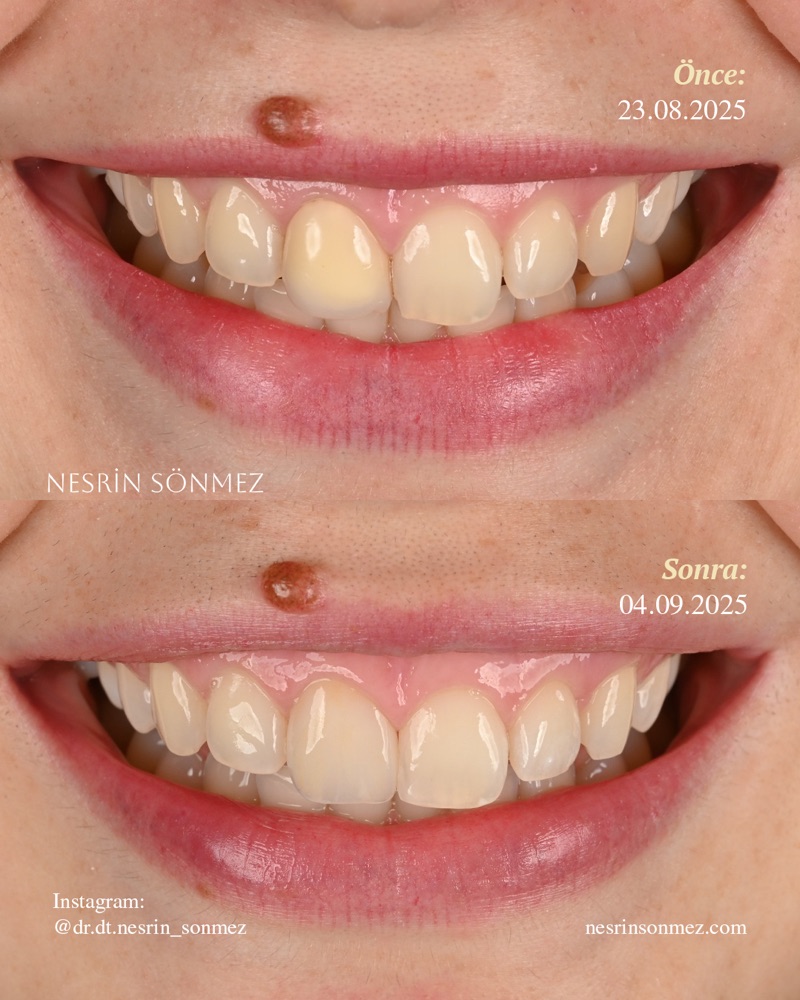 Case 1 before and after — smile view