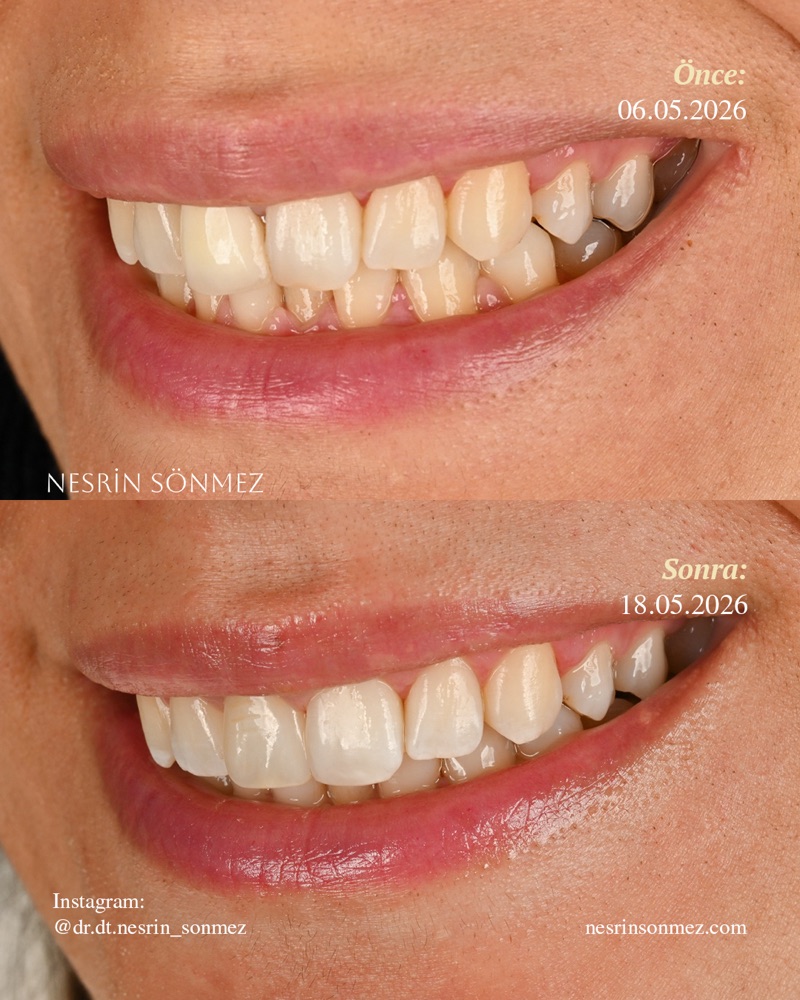 Case 2 before and after — smile view