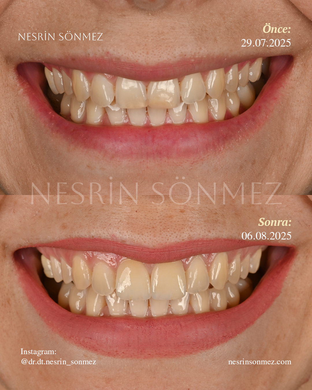 Case 11 before and after — view 1