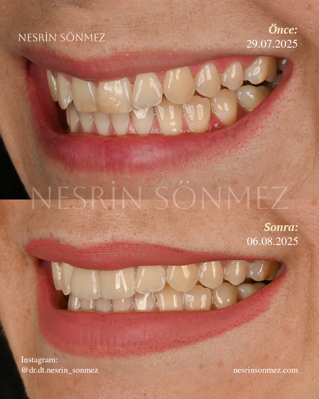Case 11 before and after — view 2