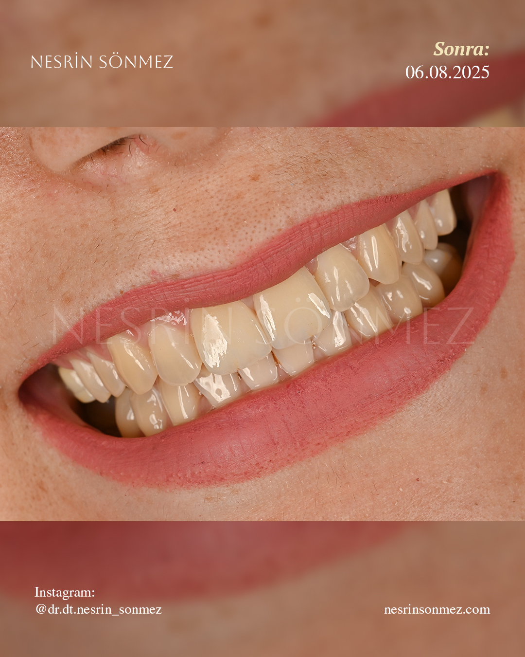Case 11 before and after — view 4