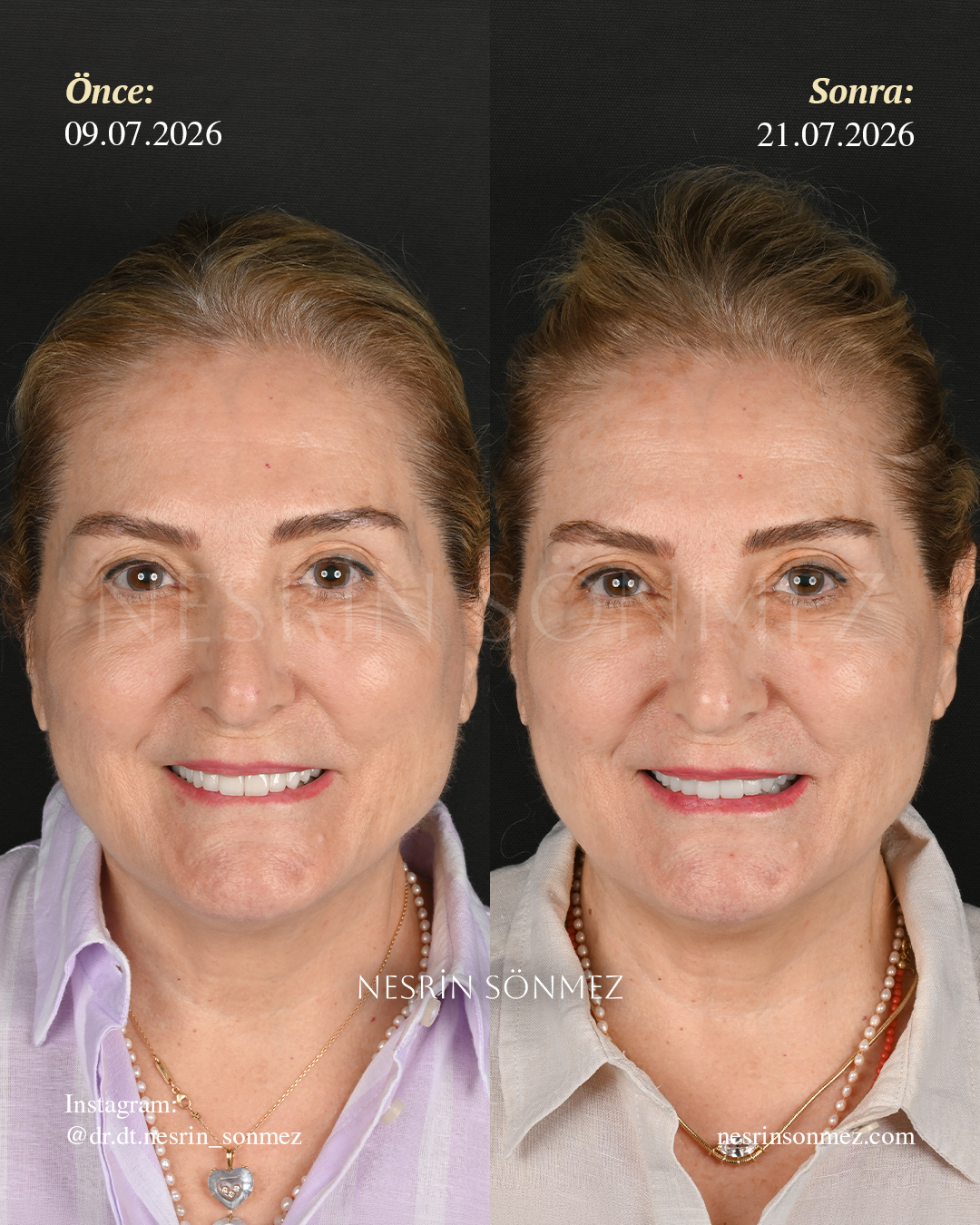Case 12 before and after — view 1