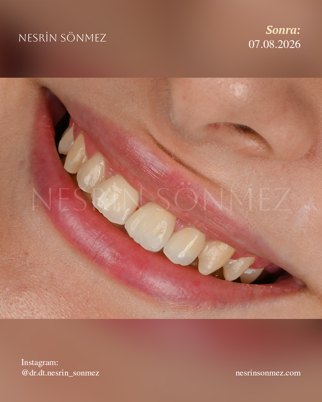 Case 13 before and after — view 4