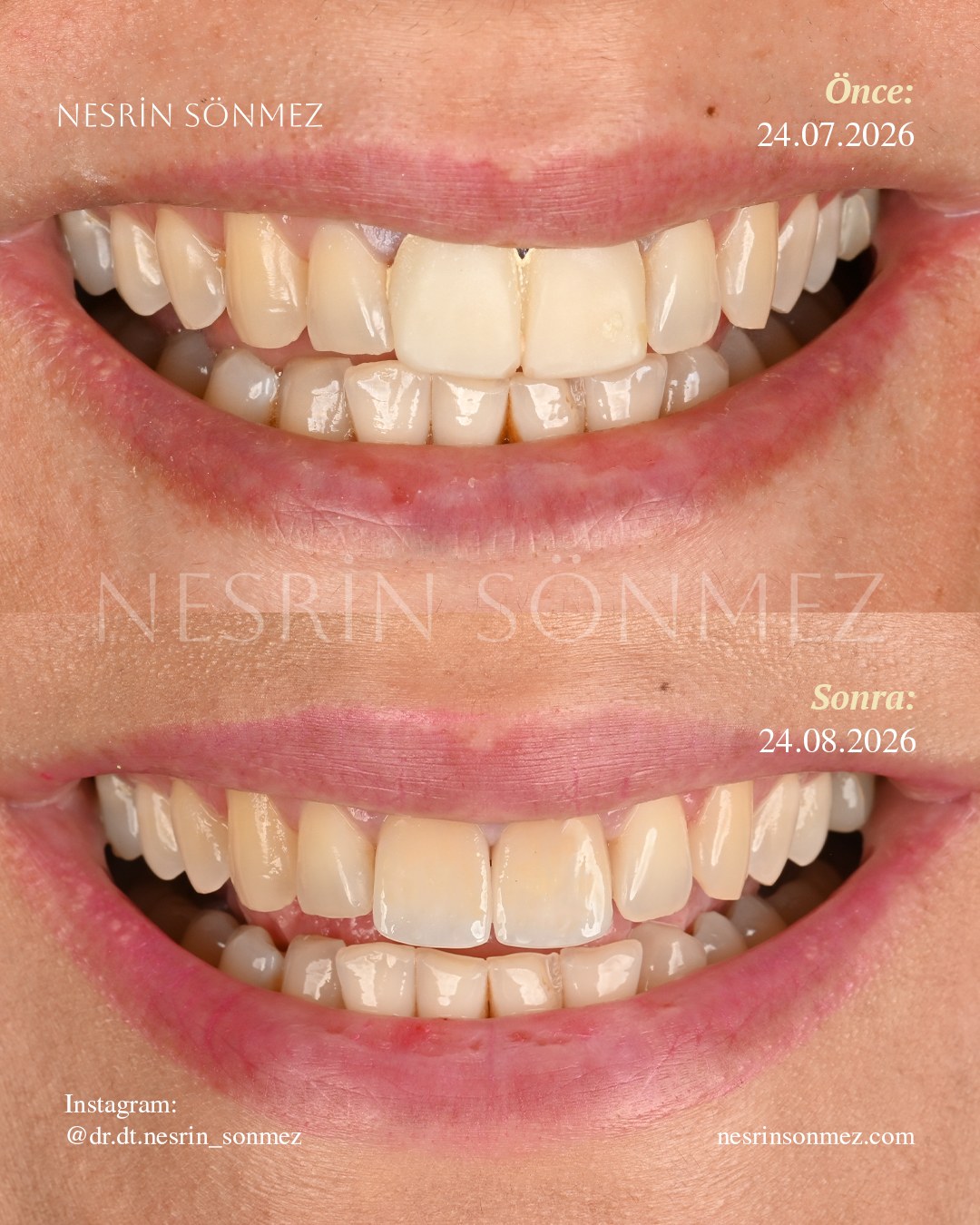 Case 14 before and after — view 1