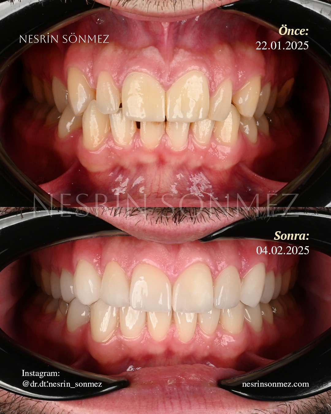 Case 16 before and after — view 4