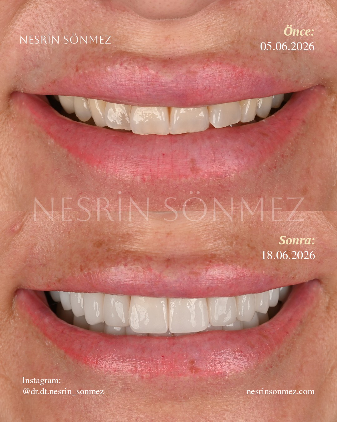 Case 17 before and after — view 1