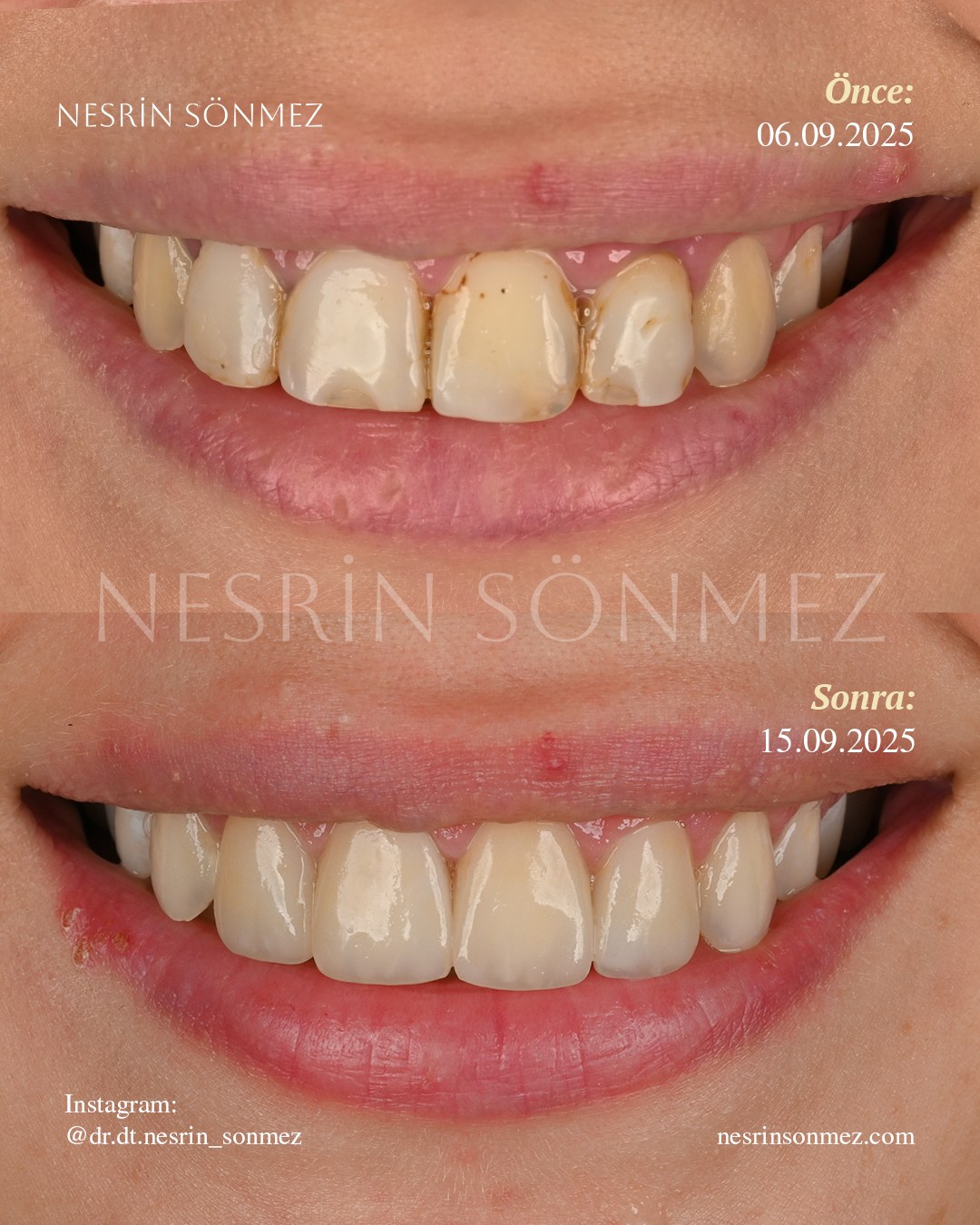 Case 23 before and after — view 1