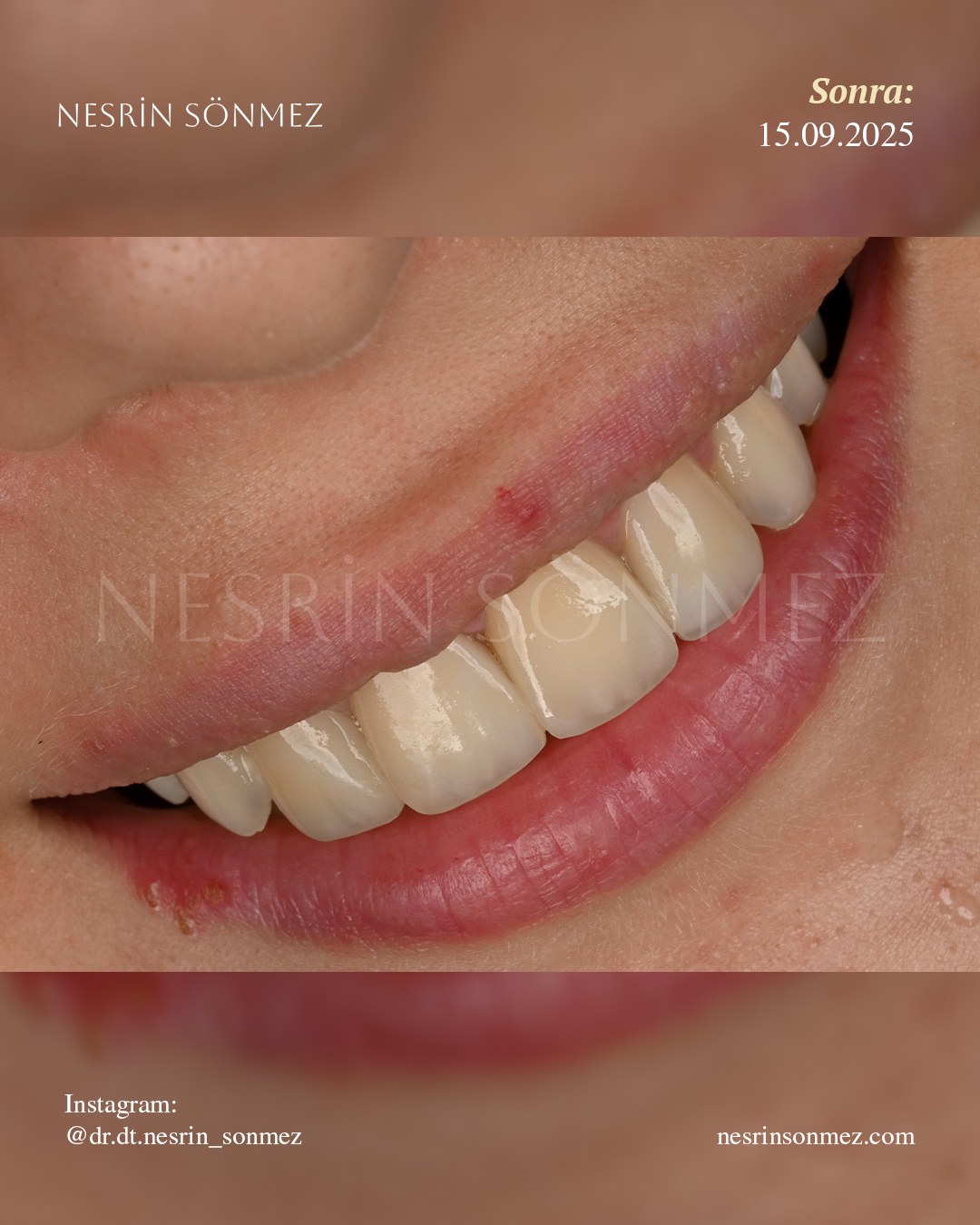Case 23 after — side view