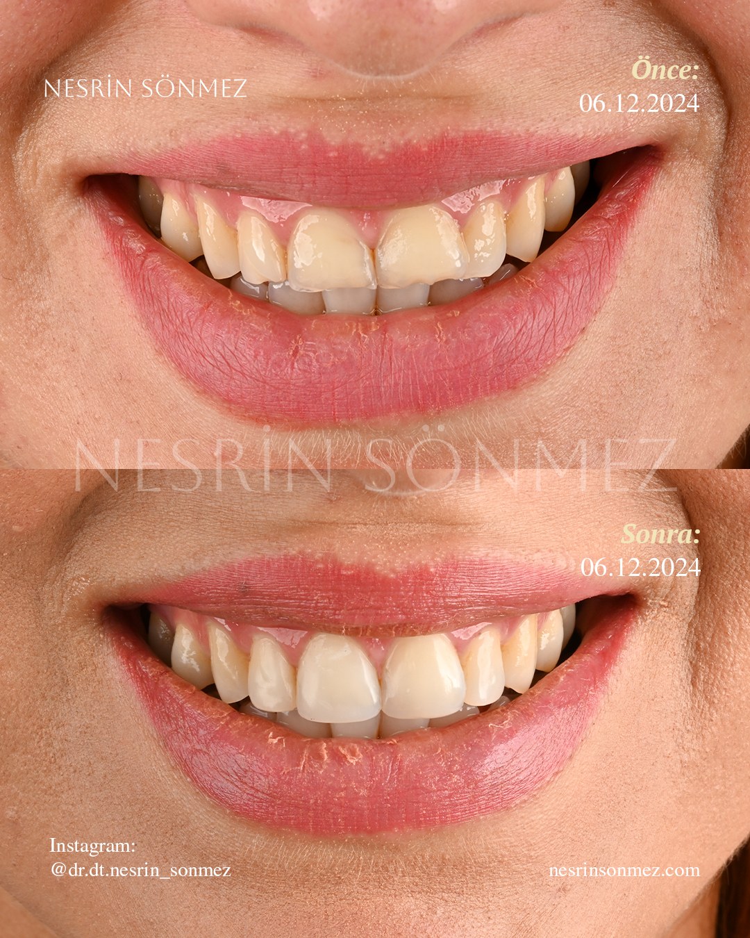 Case 25: before and after aesthetic composite filling and dental bonding