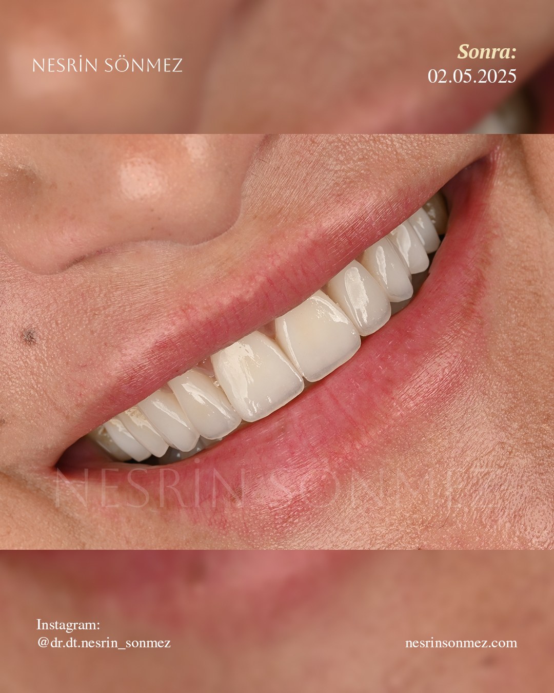 Case 26 after — side view